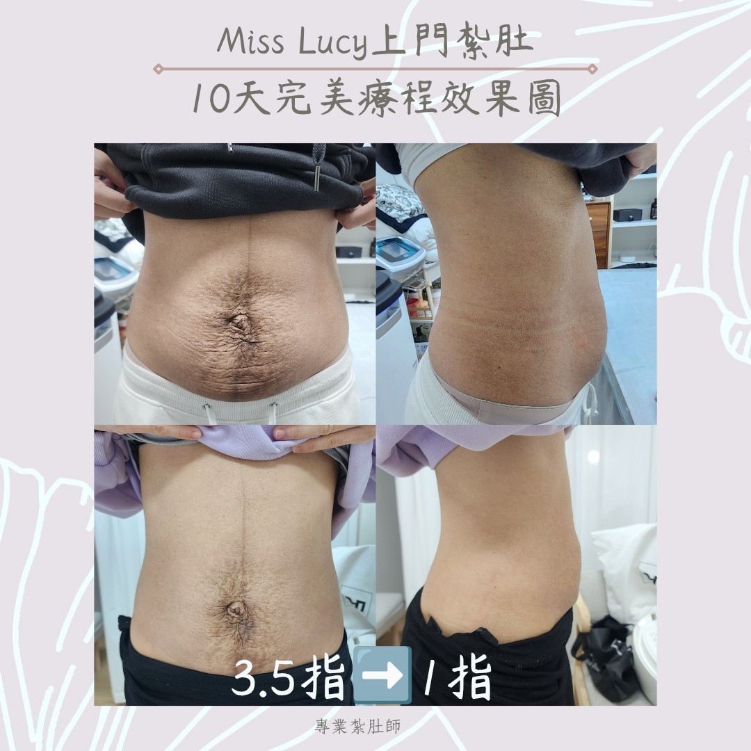 Miss Lucy 上門紮肚療程效果圖 8