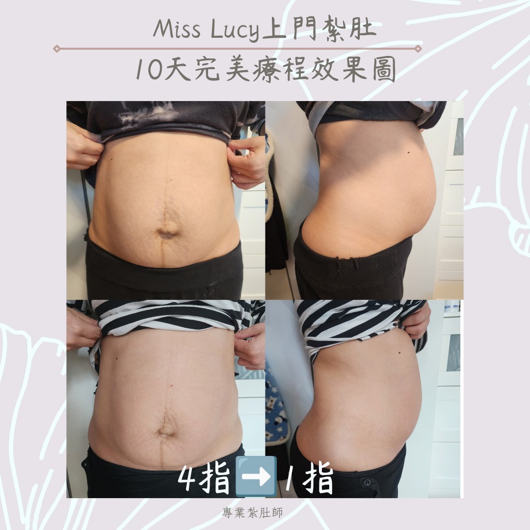 Miss Lucy 上門紮肚療程效果圖 15