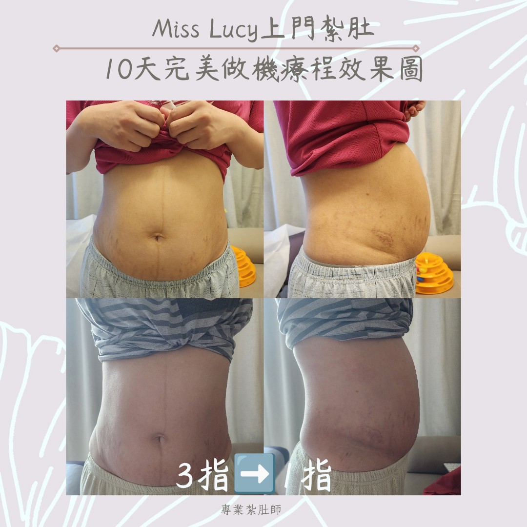Miss Lucy 上門紮肚療程效果圖 20